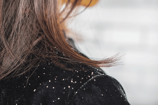 cheveux secs et electriques sur un manteau noir en hiver